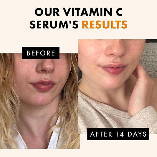 Vitamin C Face Serum - Dark Spot Remover Facial Serum
